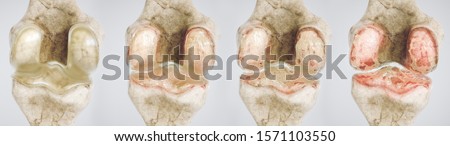 Stock fotó: Osteoarthritis Detailed Illustration From Healthy Joint To Dama