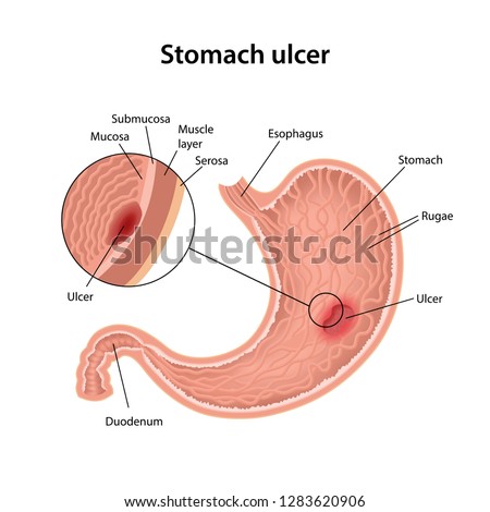 Stock fotó: Peptic Ulcer Of The Stomach On A White Background At The Bottom