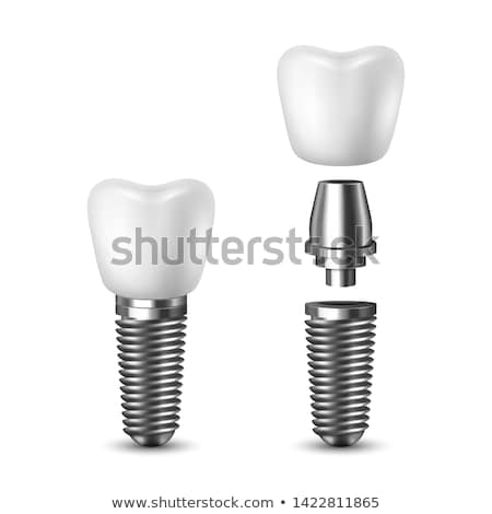 ストックフォト: Tooth Implant Dental Illustration Clip Art Image