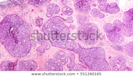Stock photo: Ductal Cancer In Situ And Invasive Ductal Cancer