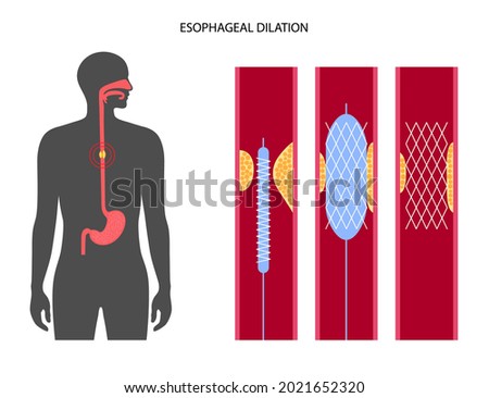 Stock fotó: Angioplasty With Stent Placement