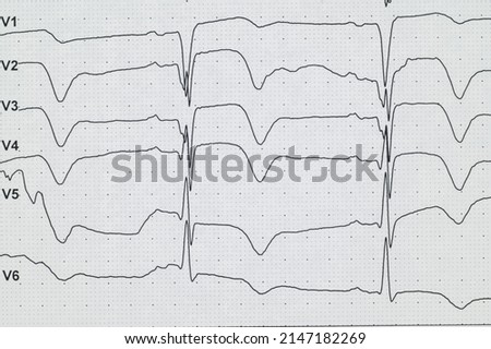 Stock photo: Heart Attack Coronary Artery Disease Heart Muscle Damage