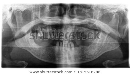 Stock photo: Details Of Black White X Ray Scan Of Human Teeth