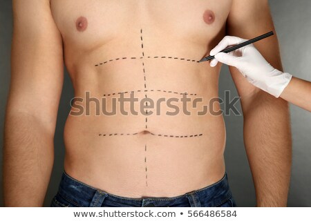 Stok fotoğraf: Liposuction And Abdominoplasty Plastic Surgery