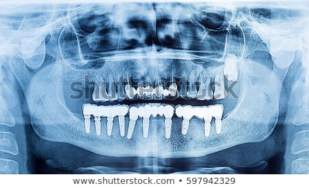Stockfoto: Dental X Ray Ceramic Teeth At Upper And Implants At Lowerr Jaw