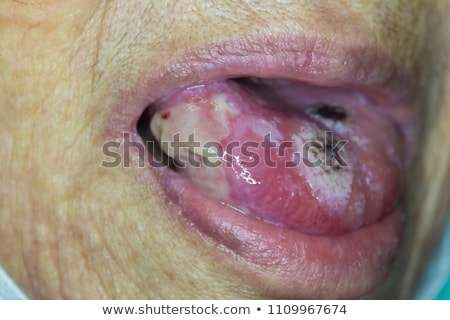 Foto stock: Tongue Cancer