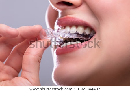 [[stock_photo]]: Woman Putting Transparent Aligner In Teeth