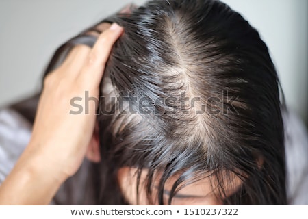 Stock fotó: Woman Bald And With Hair Human Health Problems