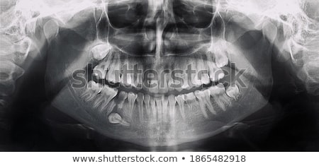 ストックフォト: Dental Wisdom Teeth Dental X Ray