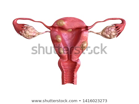Stok fotoğraf: Uterine Fibroid