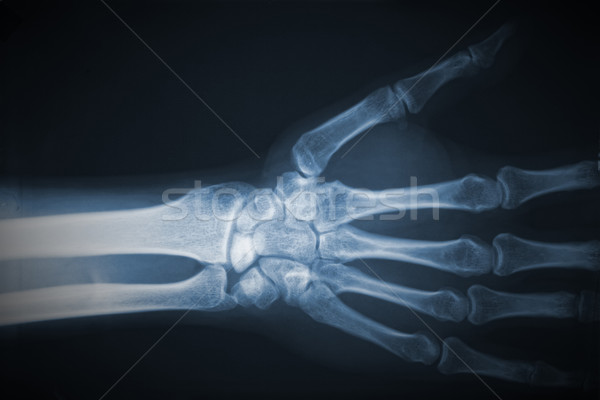 Kéz röntgen részlet film gyógyszer törődés Stock fotó © tiero