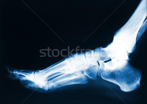 foot x-ray Stock photo © tiero