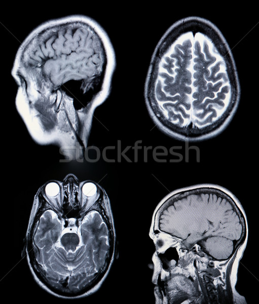 A real MRI/ MRA (Magnetic Resonance Angiogram) of the brain vasc Stock photo © tobkatrina