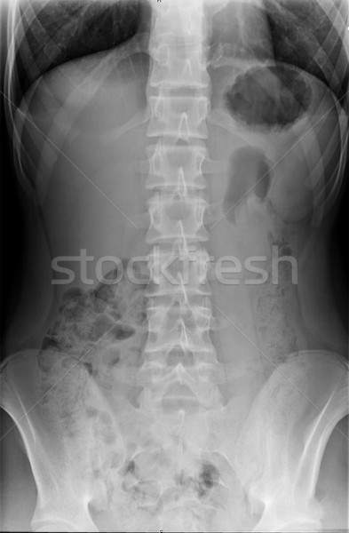 Xray Spine and Pelvis of a Human Body  Stock photo © tobkatrina