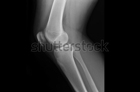 Stockfoto: Xray · knie · gewrichten · puber · ziekenhuis · menselijke