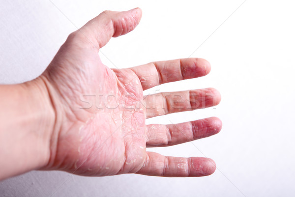 アレルギーの 皮膚 テクスチャ 患者 問題 多くの ストックフォト © traza