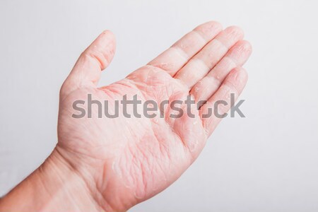 Allergic rash dermatitis leg skin of patient Stock photo © traza