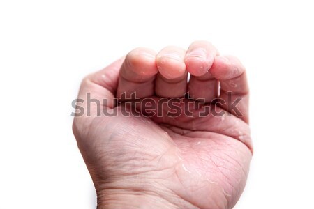eczema atopic dermatitis symptom skin detail texture Stock photo © traza