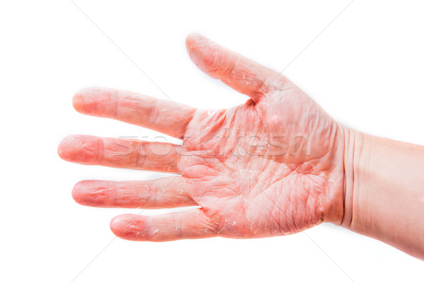 The problem with many people - eczema on hand. Isolated backgrou Stock photo © traza