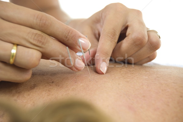 Akupunktúra tűk alkalmazás szépség hát fürdő Stock fotó © vtupinamba