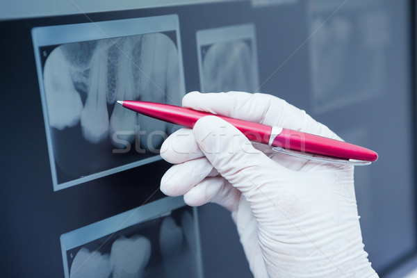 Gloved hand holding pen to teeth x-ray Stock photo © wavebreak_media