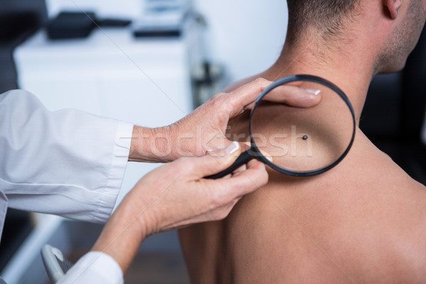 Dermatolog mol lupa clinică medic Imagine de stoc © wavebreak_media