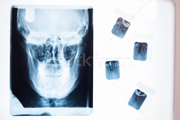 Overhead of a x-ray of a human skull Stock photo © wavebreak_media