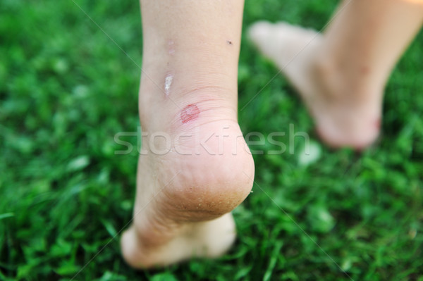Walking on grass with callus on feet Stock photo © zurijeta