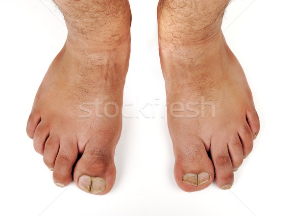 Deformado masculina pies médicos cuerpo medicina Foto stock © zurijeta