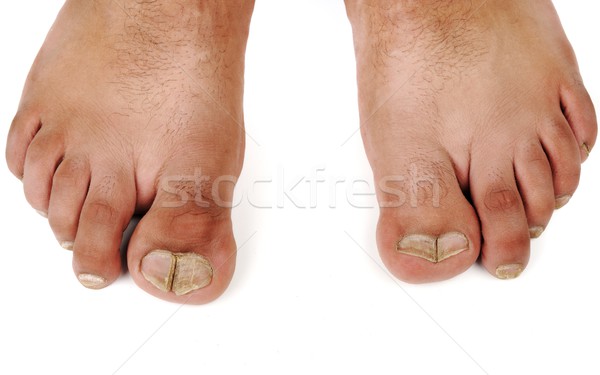 deformed male feet Stock photo © zurijeta