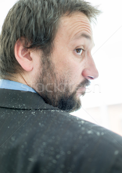 Stock photo: A man having man dandruff in the hair