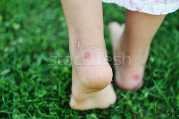 Human walking on grass with callus on feet Stock photo © zurijeta