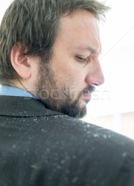 Stock photo: A man having man dandruff in the hair