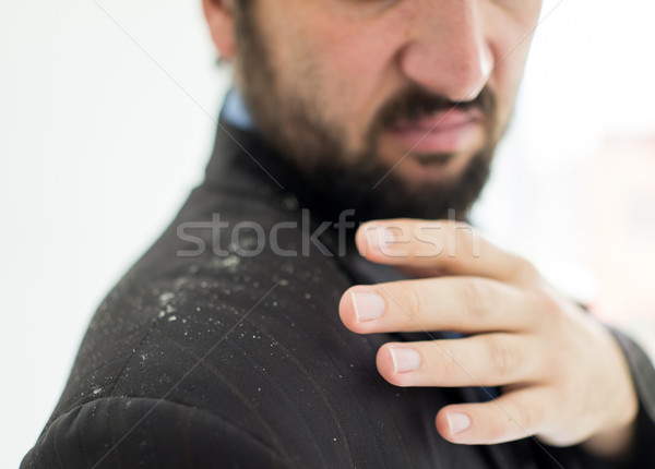 A man having man dandruff in the hair Stock photo © zurijeta